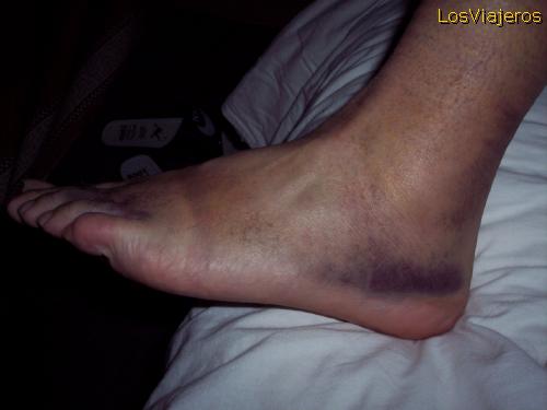 Haemorrhage in my foot -Langmusi- China
Hemorragia en el pie. Langmusi - China