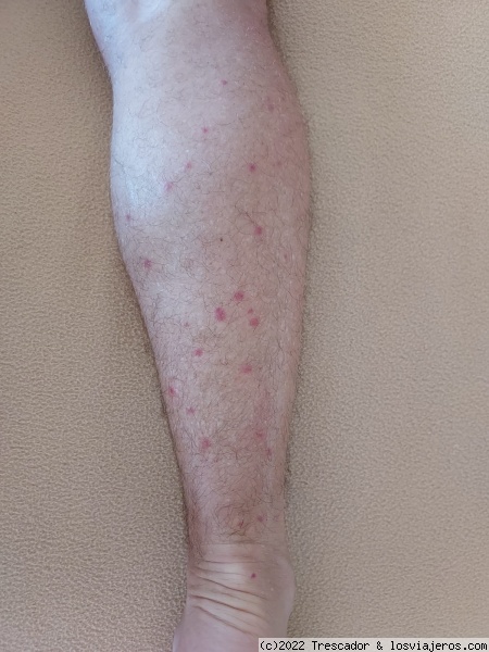 Mi pierna, llena de picaduras del mosquito Jején, supongo
Picaduras del mosquito Jején, en Cayo Coco Cuba
