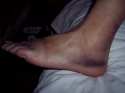 Haemorrhage in my foot -Langmusi- China